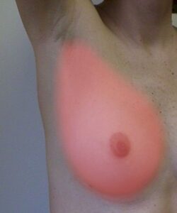 Breast tissue extends up to the axilla