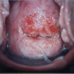 Moderate dysplasia as viewed with colposcopy