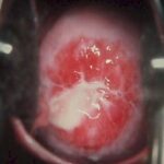 Speculum view of the cervix with chlamydia-related cervicitis