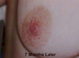 Same nipple, 7 months later