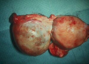 Simple cyst of the ovary, in a hysterectomy specimen (cyst on your left, uterus on your right)