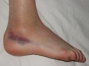 Contusion from a sprained foot