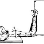 Figure 1-17. Side arm traction.