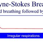 graphic showing Cheyne_Stokes_Breathing