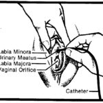 Inserting the catheter in a female.