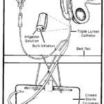 Foley triple lumen catheter. Used to catheterize a male.