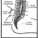 Sites for spinal anesthetics