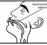 Oropharyngeal airway in place.