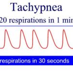 graphic showing Tachypnea - Rapid Breathing