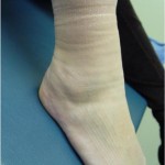Ankle edema shown after her sock was removed