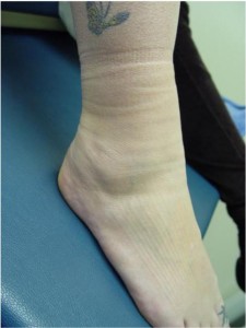 Ankle edema shown after her sock was removed