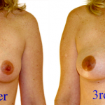 Breast Changes during Pregnancy