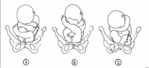 Figure 10-4. Breech positions.