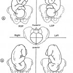 Figure 10-5. Examples of fetal vertex presentations in relation to quadrant of maternal pelvis.