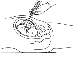 Figure 2-8. Amniocentesis.