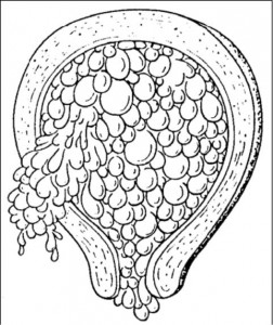 Figure 3.4 Hydatidiform Mole