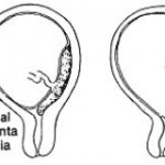 Figure 6-5. Various degrees of placenta previa.