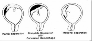 Figure 6-6. Various degrees of placenta abruptio.