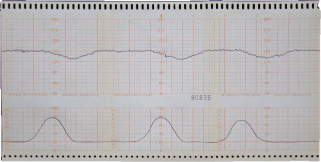 reactive fetal heart rate tracing