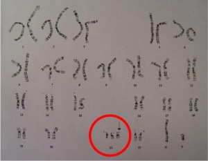 Chromosome pattern of Down Syndrome (Trisomy 21) showing three "X" chromosomes instead of the usual two.