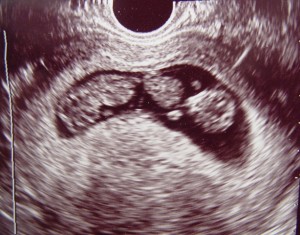 Ultrasound image of twins in the first trimester