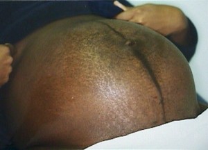 This patient has both striae gravidarum (stretch marks) and the midline linea nigra