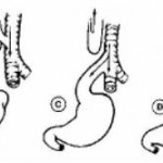 Figure 11-3. Tracheoesophageal fistula and esophageal atresia.