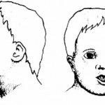 Figure 11-4. Clinical features of Down's syndrome.