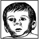 Figure 11-5. Infant with fetal alcohol syndrome.