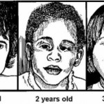 Figure 11-6. Children with fetal alcohol syndrome.