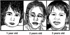 Figure 11-6. Children with fetal alcohol syndrome.