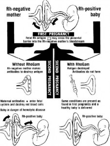 1.11 Rh Incompatibility - Obstetric and Newborn Care II