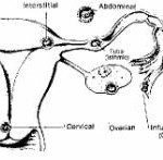 Figure 1-3. Sites of ectopic pregnancy.