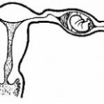 Figure 1-4. Tubal pregnancy.