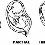 Figure 1-5. Types of placenta previa.
