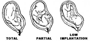 Figure 1-5. Types of placenta previa.