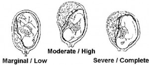 Figure 1-6. Types of abruptio placentae.
