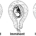 Figure 1-7. Some types of abortion.