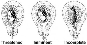 Figure 1-7. Some types of abortion.