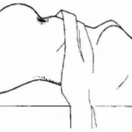 Figure 2-12. Bulging of the lower abdomen.