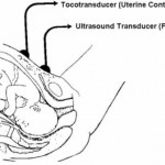 Figure 2-4. External fetal monitoring,
