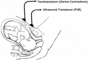 Figure 2-4. External fetal monitoring,