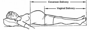Figure 4-3. Level of anesthesia for cesarean and vaginal delivery.