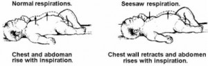 Figure 7-1. Infant's respirations.