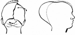 Figure 7-2. Molding of infant's head.