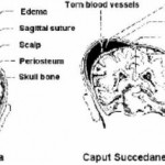 Figure 7-4. Cephalohematoma and caput succedaneum.
