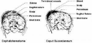 Figure 7-4. Cephalohematoma and caput succedaneum.