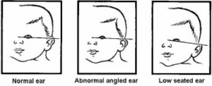 Figure 7-5. Structure of infant's ear.