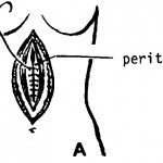 Closing the Peritoneum