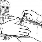 Figure 4-3. Scrub handing tonsil hemostat to surgeon.